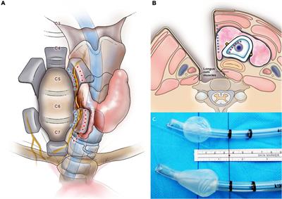 A Tapered Cuff Tracheal Tube Decreases the Need for Cuff Pressure Adjustment After Surgical Retraction During Anterior Cervical Spine Surgery: A Randomized Controlled, Double-Blind Trial